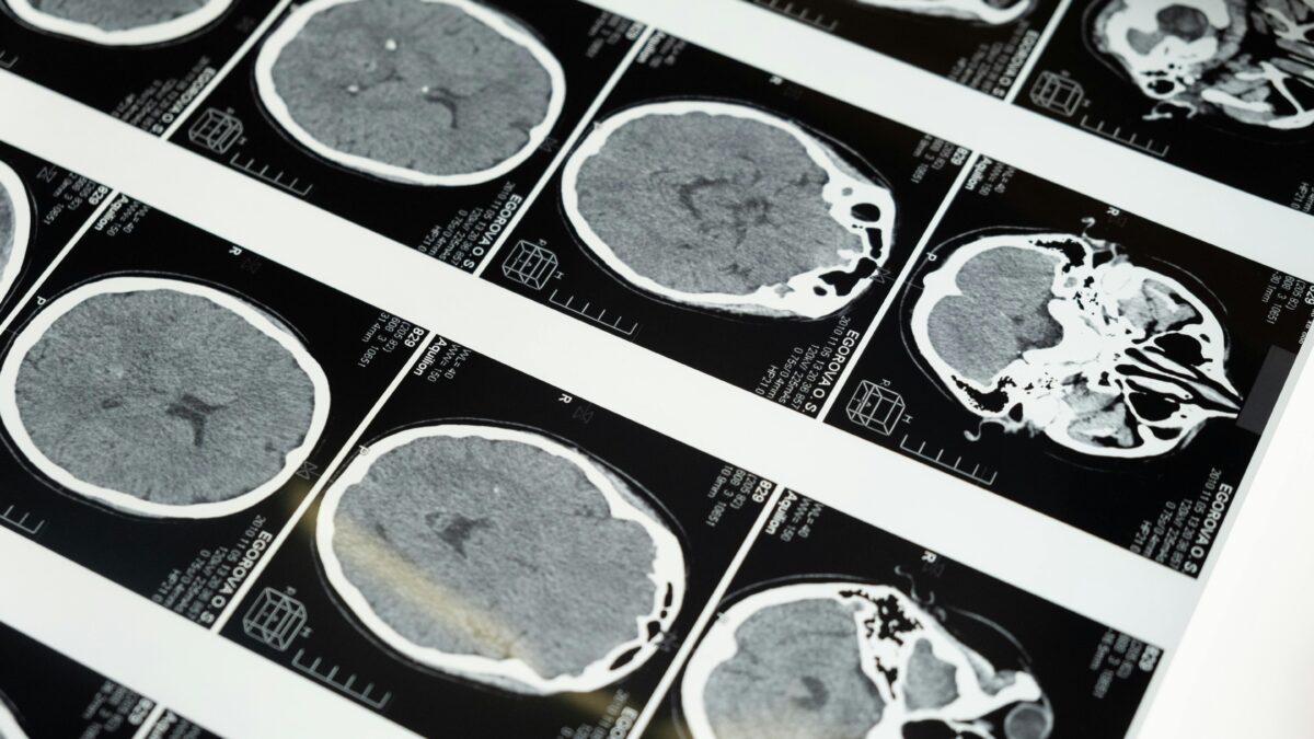 Estudo mostra que Alzheimer pode se desenvolver já na adolescência