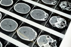 Estudo mostra que Alzheimer pode se desenvolver já na adolescência