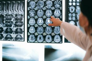 Tuberculose no Brasil: Por que a doença avança e o que podemos fazer para revertê-la?