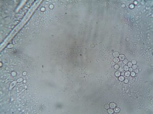 Calculo renal e bactérias: a descoberta que pode revolucionar tratamentos e sua saúde